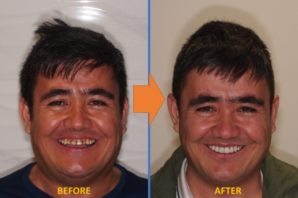Case Study 2 Prosthodontic Veneers eDentistry Wantirna