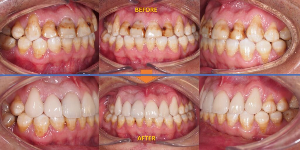 Case Study 1 Prosthodontic Veneers eDentistry Wantirna