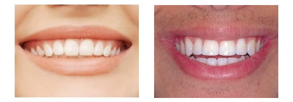 Creating-Not-Just-Straight-Teeth-But-A-Beautiful-Smile-eDentistry-Wantirna