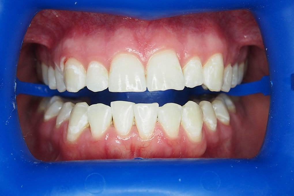 get-rid-of-brown-stains-on-teeth-teeth-whitening-case-study