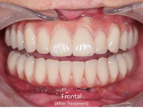 Frontal View of the Mouth - After Treatment