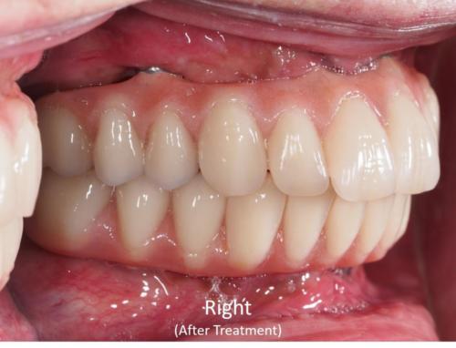 Right View of the Mouth - After Treatment
